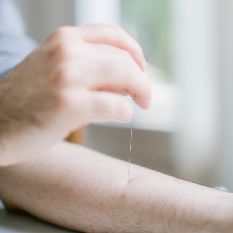 acupuncture-05