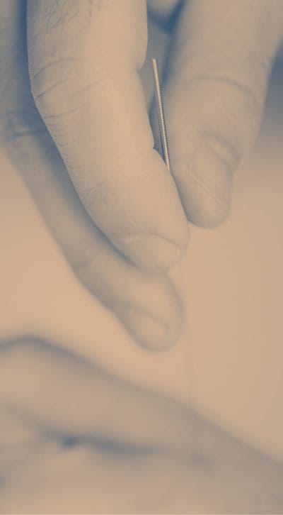 acupuncture-10
